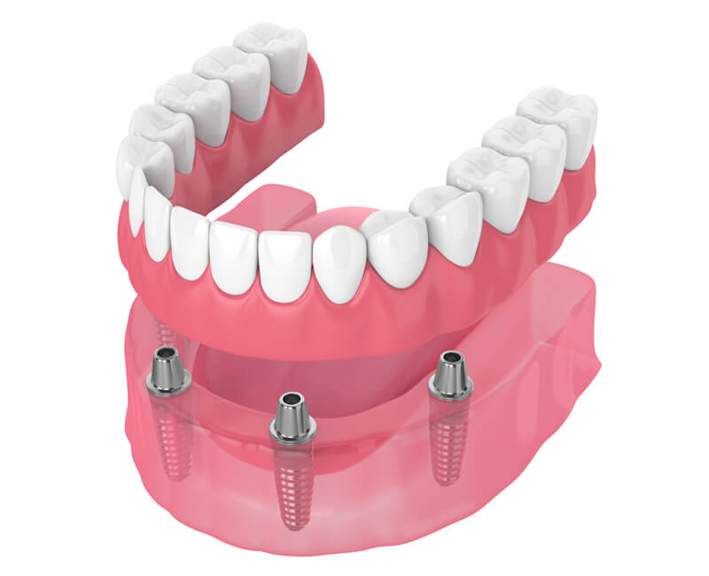 Implant-Supported-Dentures